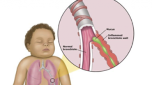 Bronquiolite Viral: A Doença Respiratória