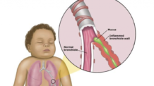 Bronquiolite Viral: A Doença Respiratória que Preocupa os Pais