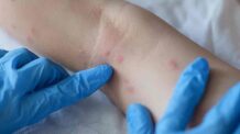Com Doença Controlada, MS Registra Dois Casos Confirmados da Varíola dos Macacos