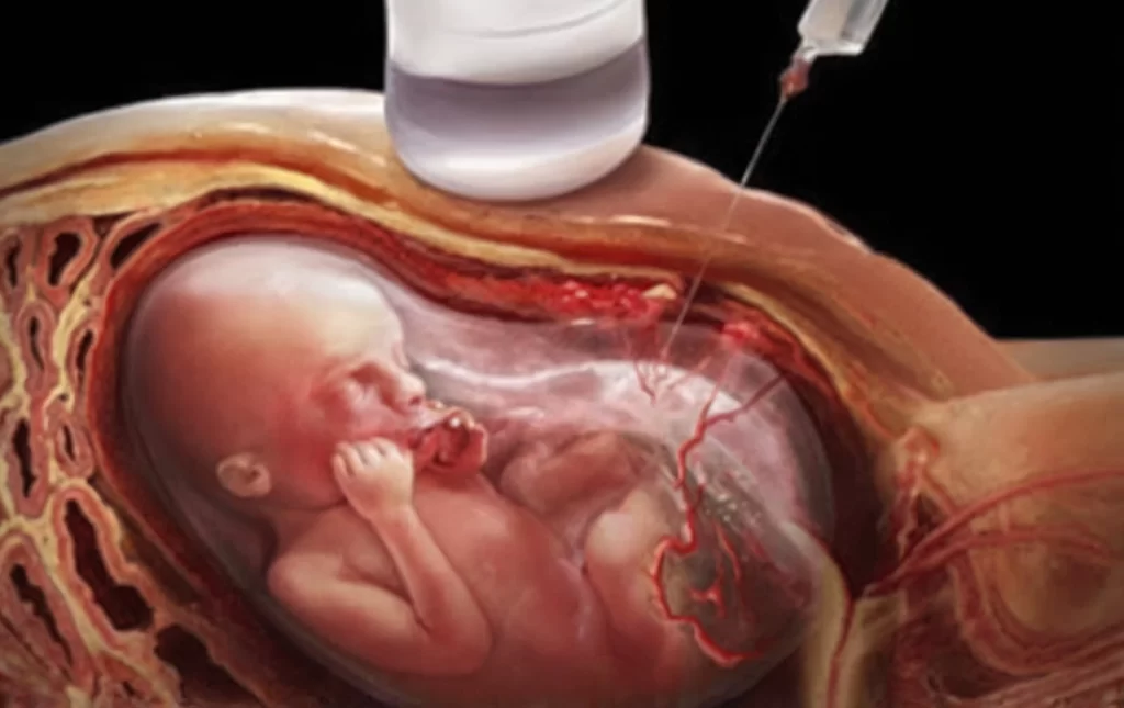 A imagem apresenta uma representação artística de um feto em um útero, com um soro sendo injetado diretamente no cordão umbilical. A imagem é em tons de rosa e vermelho, e o feto é mostrado em um ângulo que permite ver a sua postura e o seu rosto. O soro é injetado por um cateter, que é colocado na parte superior da imagem. O fundo é preto, o que destaca a imagem e o soro. A imagem é realista e detalhada, mostrando o processo de injeção de soro no cordão umbilical com precisão.